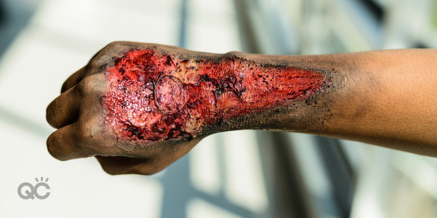 special effects makeup skin burns