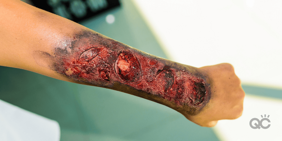 How to Create a Special Effects Makeup Look Blog - Burn Makeup on Arms