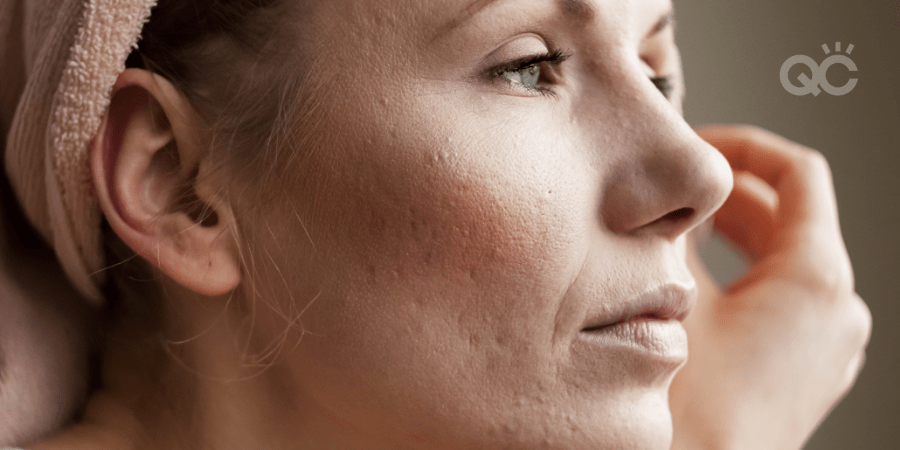 close up of woman's face with acne and scarring on skin