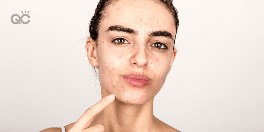 woman with acne pointing to chin area with finger