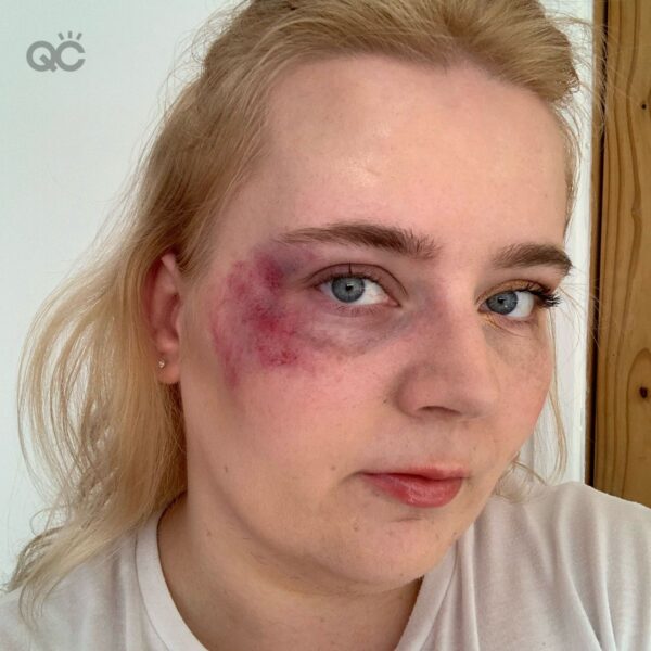 Gemma eye bruise tutorial final result