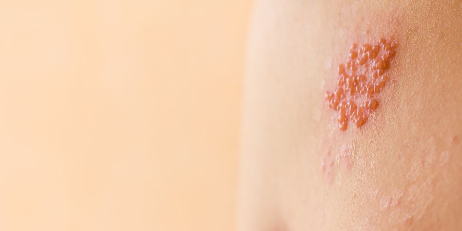 Shingles on men herpes zoster. Skincare consultant skin conditions article.