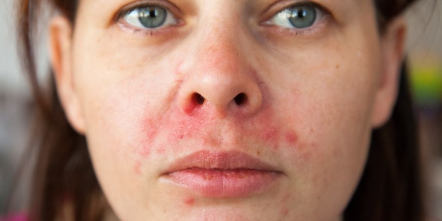 Skin conditions you'll see as a skincare consultant in-po0st image 13